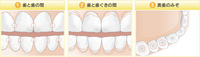 歯１.jpegのサムネイル画像